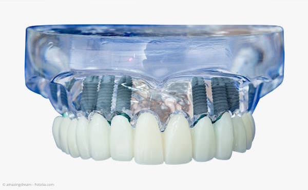 Komplett festsitzende Zähne mit Implantaten